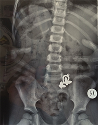 X-Ray of a Belly Ring in the Belly - Not the Traditional Way